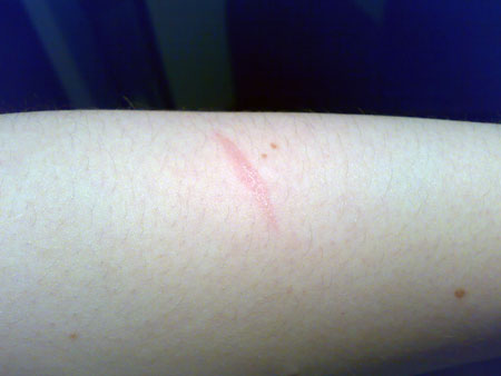Burn mark on my arm
